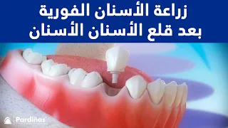 زراعة الأسنان الفورية بعد قلع الأسنان ©