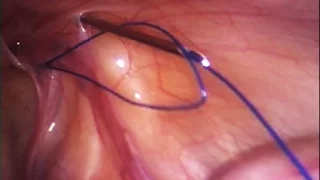 Pediatric inguinal hernia repair - Percutaneous internal ring suturing (PIRS)