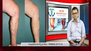 Treatment for Varicose Veins  Explained by Dr Rajah V Koppala  | Avis Hospitals