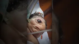 Baby Born With One Eye 😱😢