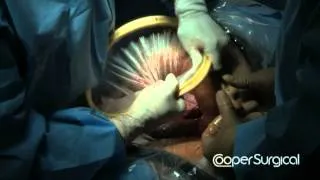 OB Mobius C-Section with Dr Gwen Allen