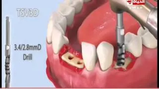 إنتبهوا أيها السادة - " د/محمد عماد " - فيديو يوضح عملية زراعة الأسنان