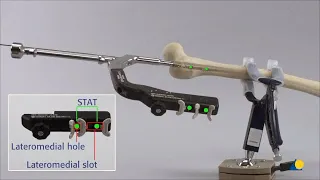 Femur, Proximal - Fracture - Intramedullary Fixation Using the Expert R_AFN - Antegrade Procedure