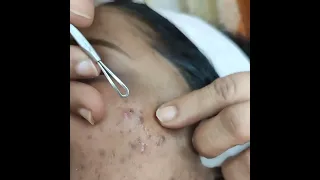 CLEANING CLOGGED PORES