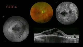 SYM39 10   White Dot Syndromes A Systematic Approach to Diagnosis   Make the Diagnosis Case Examples