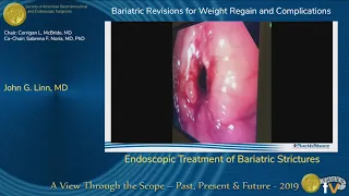 Endoscopic Treatment of Bariatric Strictures