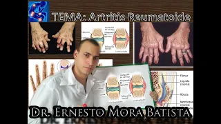 ARTRITIS REUMATOIDEA 👨🏻‍⚕️🚑🇨🇺🇨🇴🤩🦾💪🏻