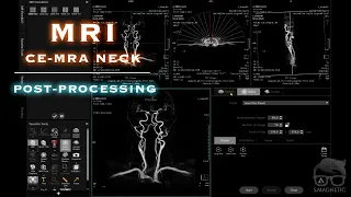 MRI – CE-MRA NECK & POST-PROCESSING