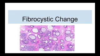 Fibrocystic Disease of Breast