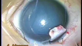 approach to canal  of schlemm in trabeculotomy trabeculectomy surgery