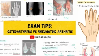 Exam strategy: Osteoarthritis vs Rheumatoid Arthritis | MedStudier