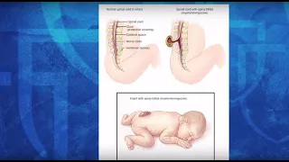 #AsktheMayoMom about Fetal Surgery for Spina Bifida