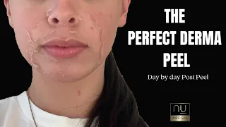 The Perfect Derma Peel | Day by day peeling process | Chemical Peel | NU Med Spa