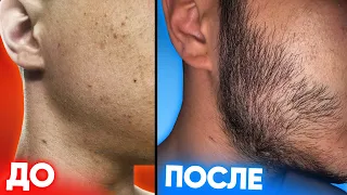 РЕЗУЛЬТАТ КСИНОКСИНА: Борода с нуля за 3 месяца в 17 лет