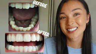 INVISALIGN REVIEW | Before and after pics, Cost, Composite Bonding, Whitening etc.