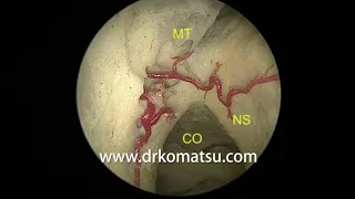 #A5 Sphenopalatine artery; Anatomy for Endoscopic Endonasal Skull Base Surgery