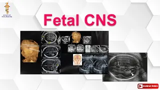 Fetal CNS