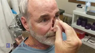 Anatomically Retained Nasal Prosthesis