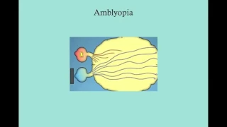 Amblyopia   CRASH! USMLE Step 2 and 3