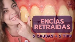 🤔 Las ENCÍAS RETRAÍDAS tienen solución? 🥺 5 CAUSAS y 5 TIPS para PREVENIRLO ✅