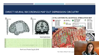 Personalized Brain Stimulation in Psychiatry