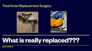 What is actually replaced when I have a knee replacement? Is the whole knee replaced? Steps of a TKA