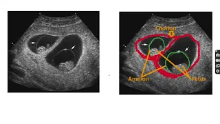Anatomy of monochorionic diamniotic twin pregnancy #twin #anatomy #pregnancy #twinpregnancy
