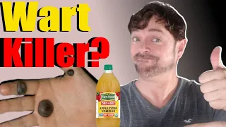 EASY! Remove Warts with Apple Cider Vinegar | 3 Steps! | Chris Gibson