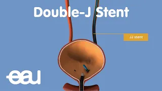 JJ Stent (removal of kidney stones)