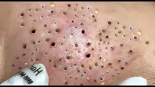 Relax Skincare Everyday with Acne Blackheads Treatment Spa #97907