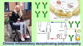 chronic inflammatory demyelinating polyneuropathy