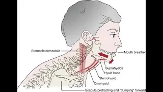 A common cause of TMD: Suprahyoid muscle clenching