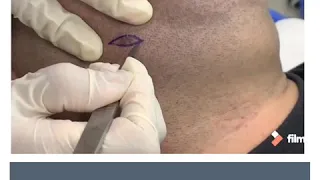 Mole Removal - Cut & Excision by Dr. Anvika