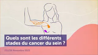 Quels sont les différents stades du cancer du sein ?