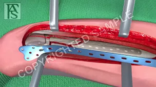 Broken Leg Surgery Femur Fracture Animation