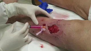 SMH MyOwn Skin Graft Application