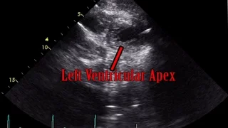 Parasternal Short Axis View Lower Apex Level - Loop