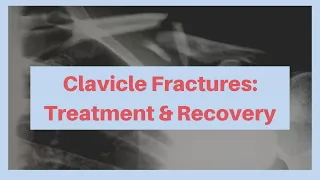 What is the treatment and recovery from a clavicle fracture?