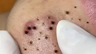 Extreme blackheads removal