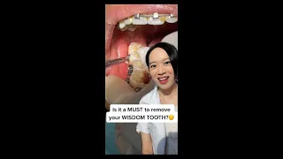 MUST you extract your Wisdom Tooth? 🤔 Here's the answer! 🤗🌟🦷 #shorts