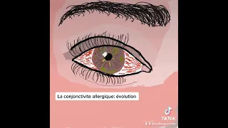 Animation conjonctivite allergique