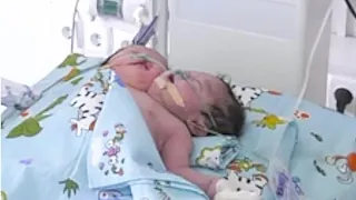 Baby kommt mit 2 Köpfen zur Welt! Heftige Bilder!