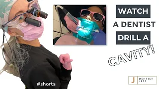 Dentist DRILLS cavity...check out massive hole at END! 👀 ASMR #shorts