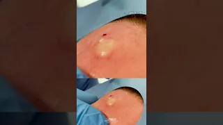 Forehead Cyst Squeezed | CONTOUR DERMATOLOGY #shorts