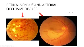Ocular Disease 2 systemic diseases 1