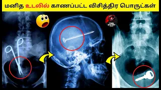 🔴மனித உடலில் காணப்பட்ட விசித்திர பொருட்கள் Strange Things Which Found In Human Body in Tamil #shorts