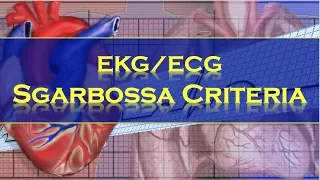 Sgarbossa Criteria Explained