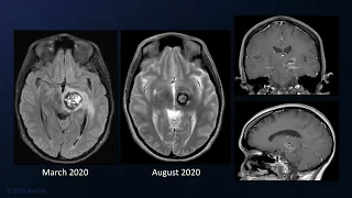 Supracerebellar-Transtentorial Approach for Resection of a Recurrent Thalamic Cavernous Malformation