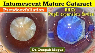 Intumescent Mature cataract Pseudoexfoliation, BHEX pupil expansion device - Dr Deepak Megur