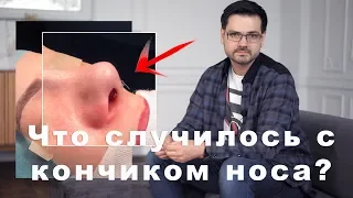 Ринопластика // ДО/ПОСЛЕ  // Секреты в операционной